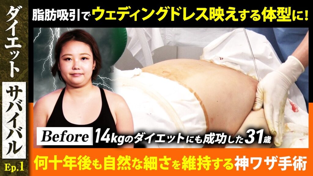 脂肪吸引でウェディングドレス映えする体型に!何十年後も自然な細さを維持する神ワザ手術 14kgのダイエットにも成功した31歳【ダイエットサバイバル#1 | 手術編 】
